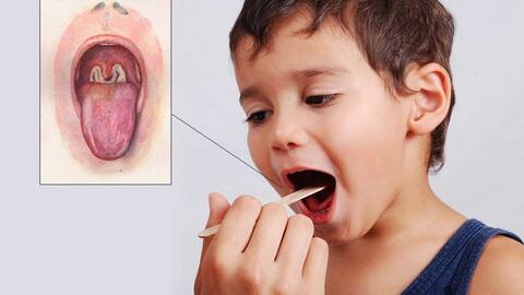 Bệnh bạch hầu: Nguy cơ lây lan ra cộng đồng thấp