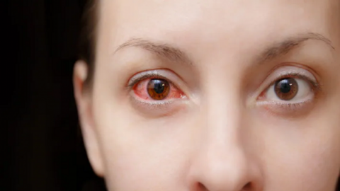 Những bệnh nhiễm trùng mắt liên quan đến COVID