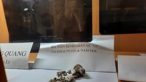 Thận ứa mủ, mất chức năng vì thói quen xấu nhiều người Việt mắc: BS cảnh báo cần thay đổi