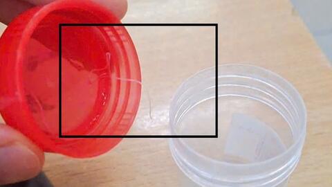 Đau nhức mắt đi khám mới phát hiện ký sinh trùng "làm tổ"